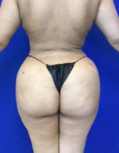 Brazilian Butt Lift Before and After Pictures Irvine, CA