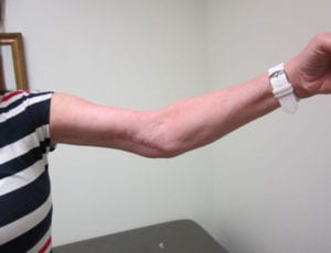 Arm Lift Before and After Pictures Irvine, CA