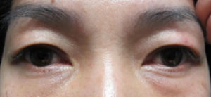 Asian Blepharoplasty Before and After Pictures Irvine, CA