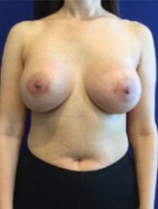 Breast Augmentation Before and After Pictures Irvine, CA