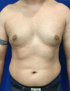 Gynecomastia Before and After Pictures Irvine, CA