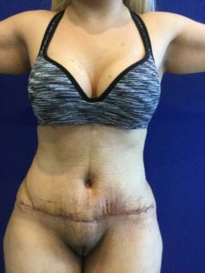 Lipoabdominoplasty Before and After Pictures Irvine, CA