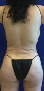 Liposuction Before and After Pictures Irvine, CA