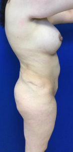 Liposuction Before and After Pictures Irvine, CA