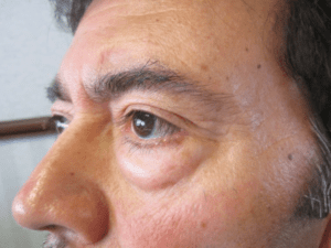 Blepharoplasty Before and After Pictures Irvine, CA