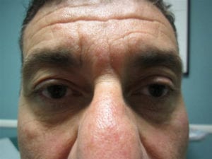 Blepharoplasty Before and After Pictures Irvine, CA