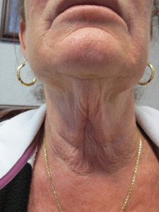 Neck Lift Before and After Pictures Irvine, CA